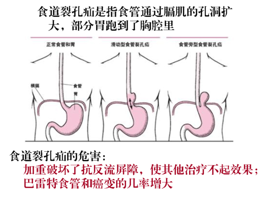 普外科成功开展首例腹腔镜食管裂孔疝修补术