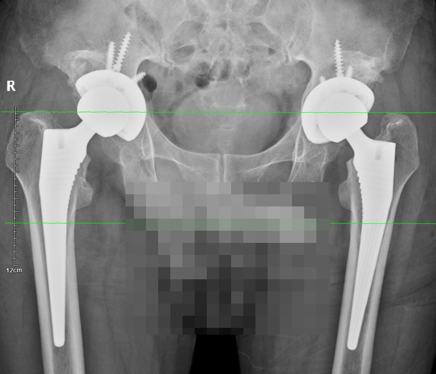 【我为群众办实事】(105) 骨一科一次住院为患者解决双侧股骨头坏死难题