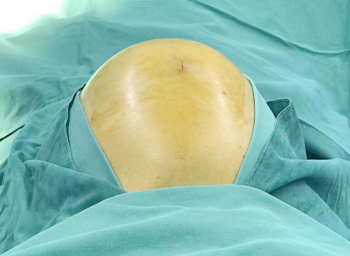 妇科成功救治一例腹膜外巨大平滑肌瘤患者