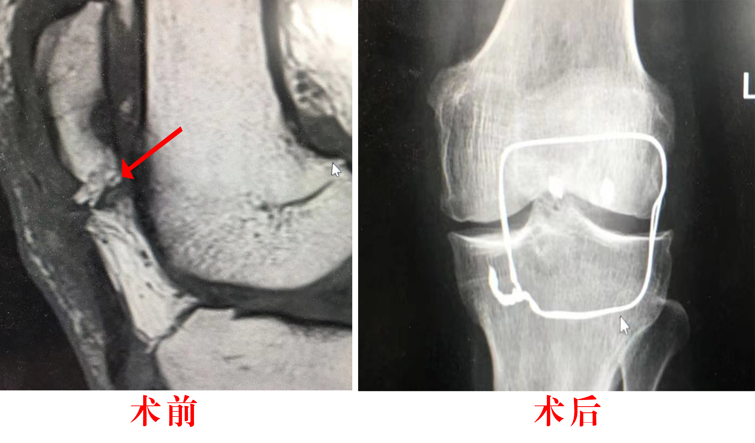 骨二科开展全县首例髌韧带断裂缝合术